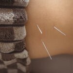 Acupuncture needles inserted on the body to help treat insomnia and improve sleep quality
