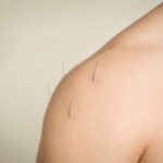 Close-up of acupuncture needles in the shoulder during treatment for anxiety and stress relief