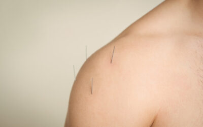Acupuncture: Anxiety and Stress Relief